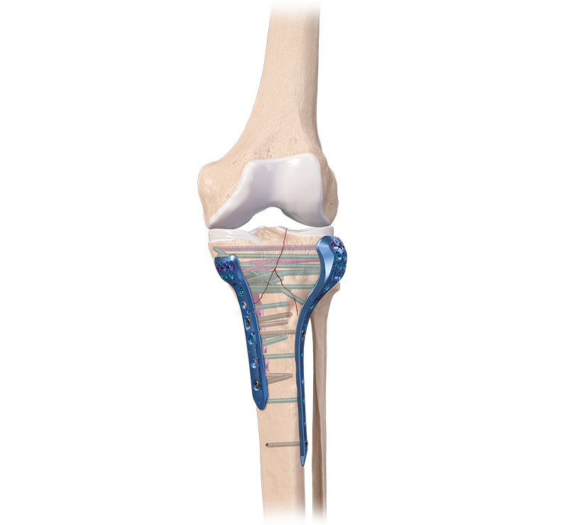 Arthrex - 2.7/3.5/4.0 mm Depth Device - AR-8943-15